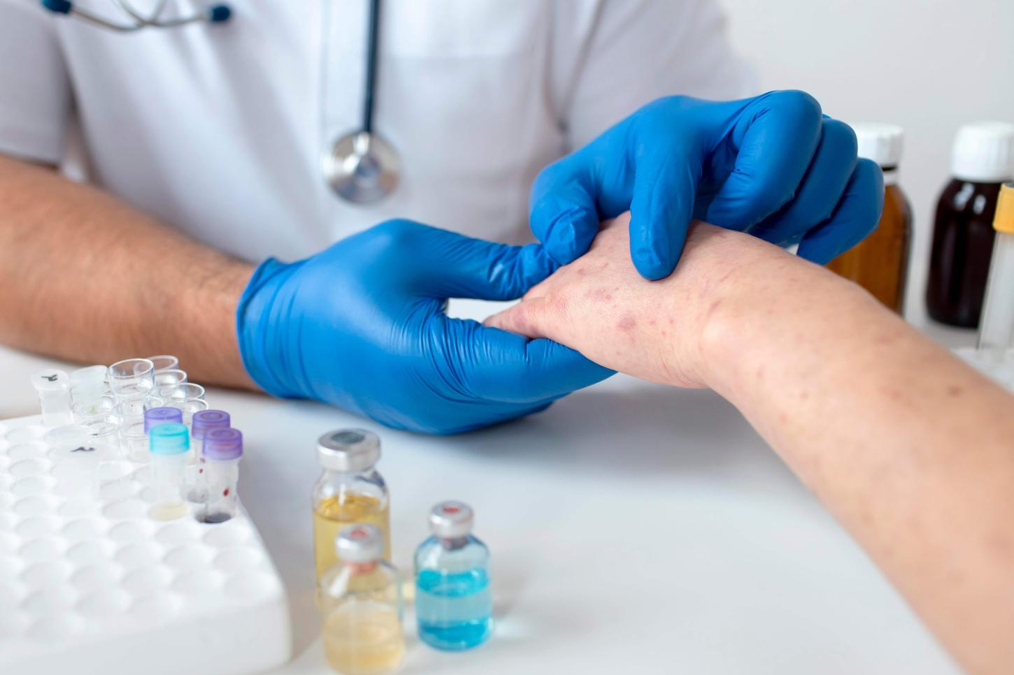 Saúde corrige dados e diz que ES registrou 8 casos de mpox em 2024
