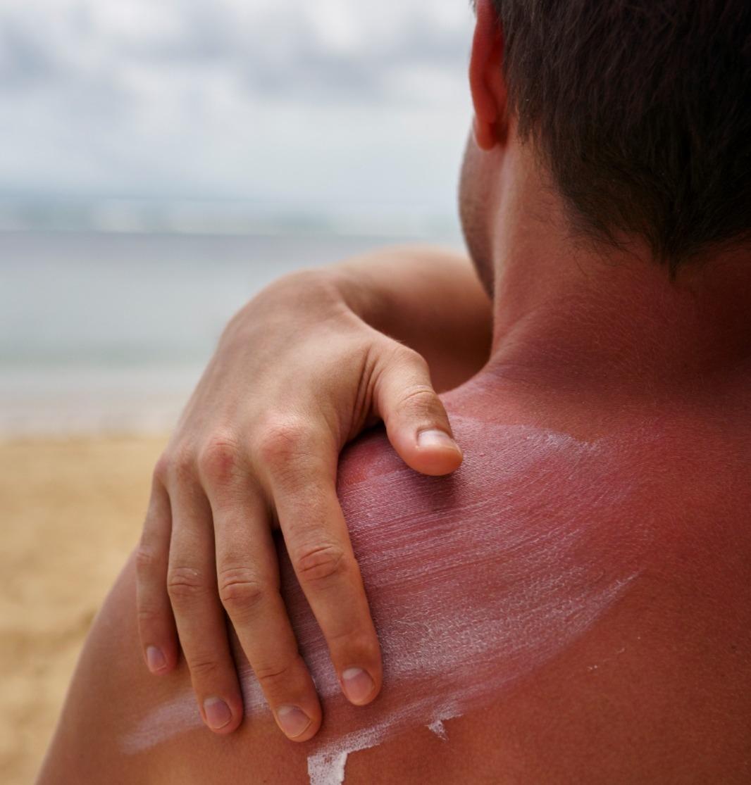 Cuidados com altas temperaturas: médico alerta para hidratação e exposição solar segura