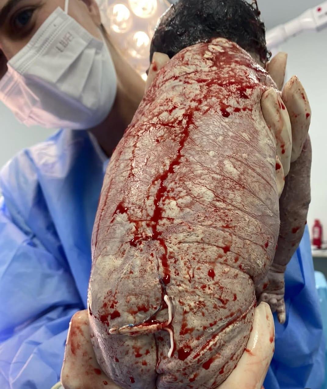 Bebê nasce com DIU preso ao corpo e caso viraliza nas redes