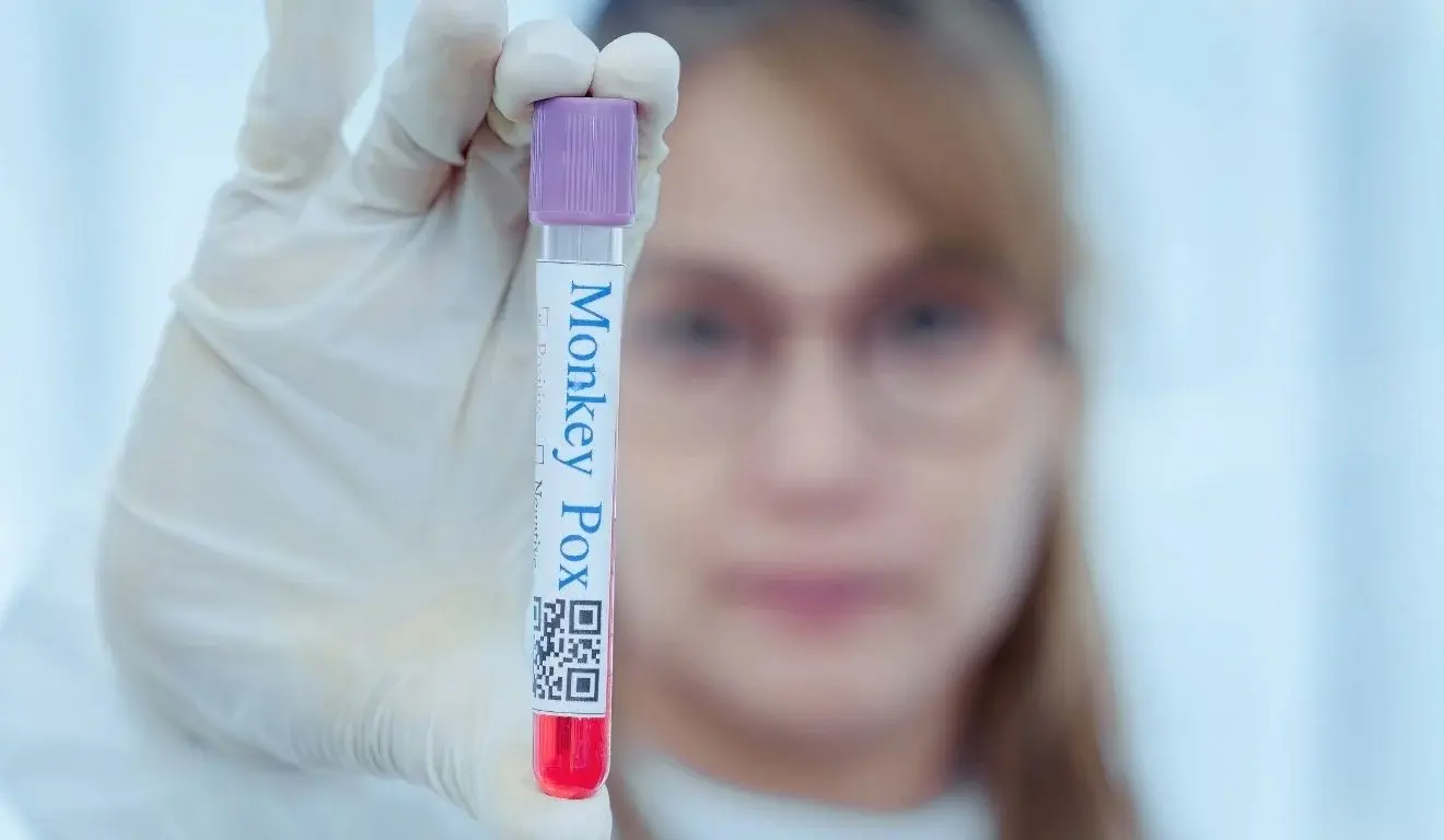 Mpox em 2026: Brasil registra 88 casos, maioria em São Paulo, e não há mortes neste ano