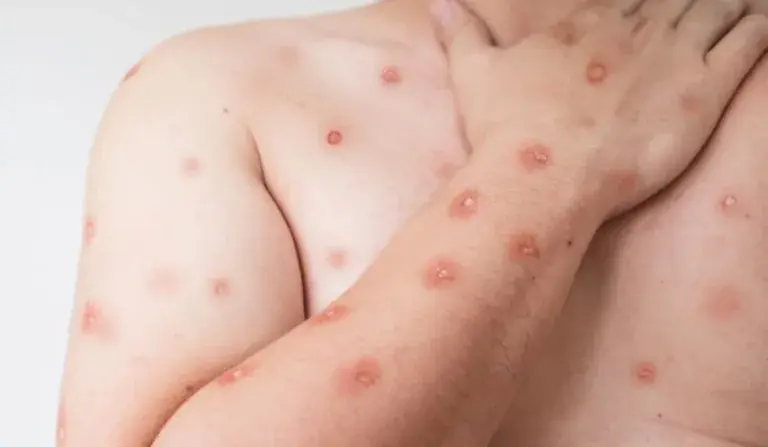 Espírito Santo confirma quinto caso de Mpox em 2026 e acende alerta para sintomas